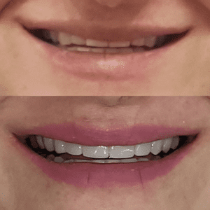 Antes e depois do sorriso-1