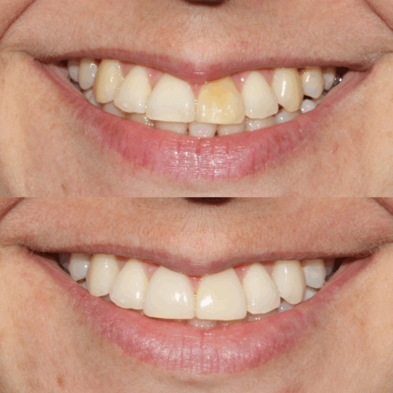 Antes e depois Paola