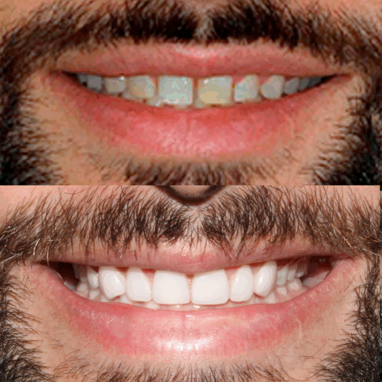 Antes e depois marco 2